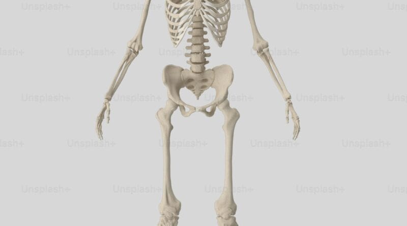 stone man syndrome
